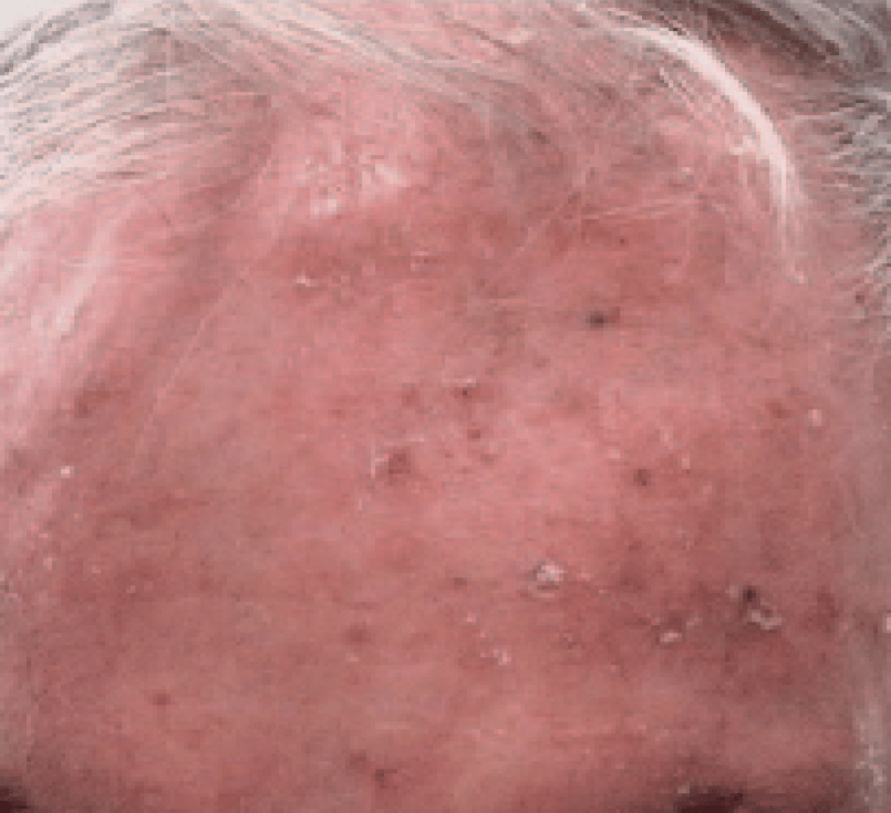 Actinic Keratoses Pennsylvania Dermatology Specialists