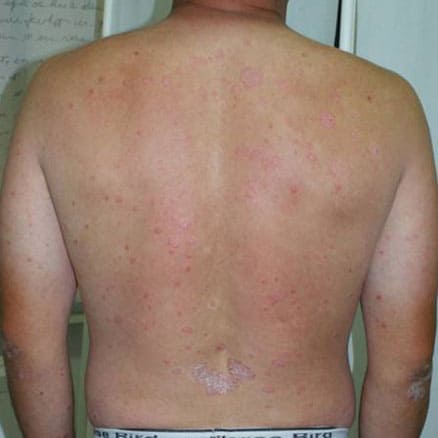 Before Phototherapy on back