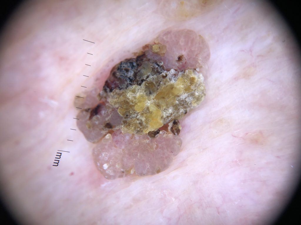 Seborrheic Keratosis