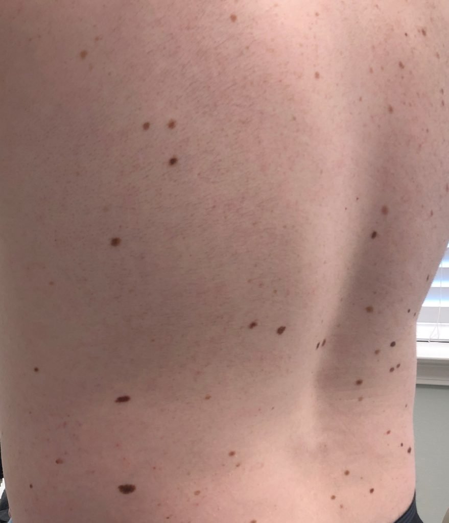 Atypical Nevus