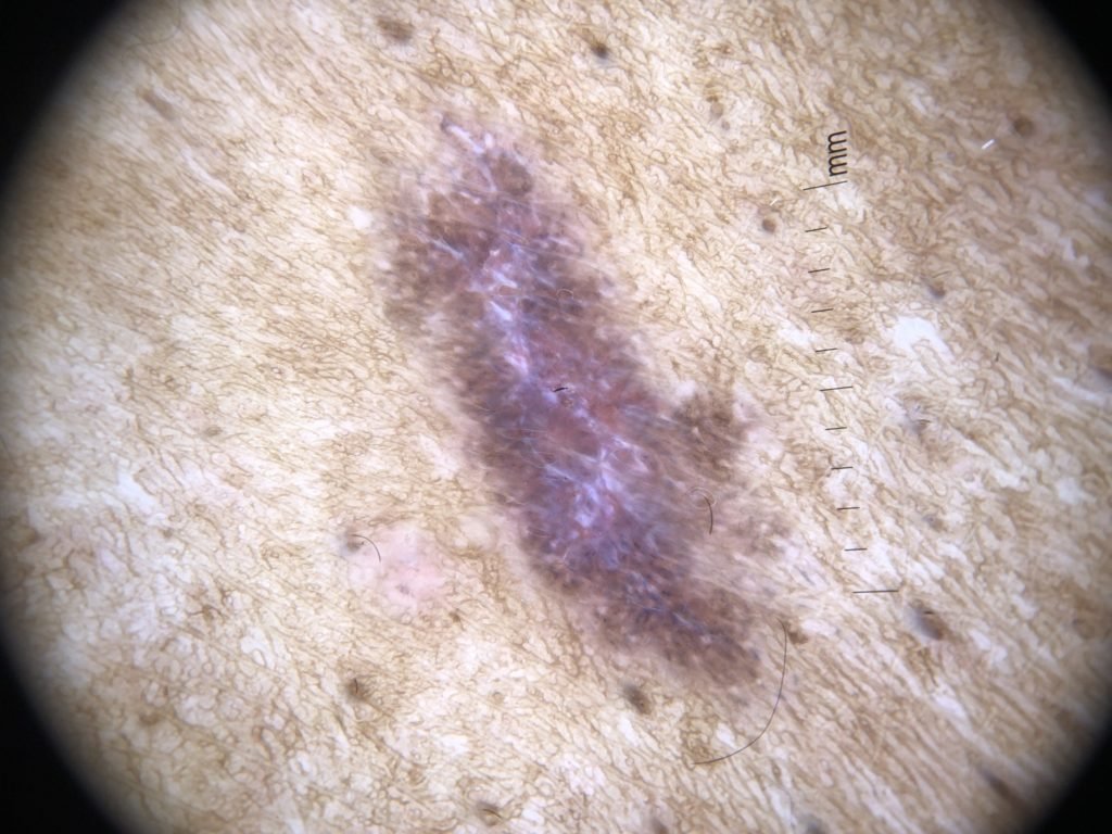 lichen planus