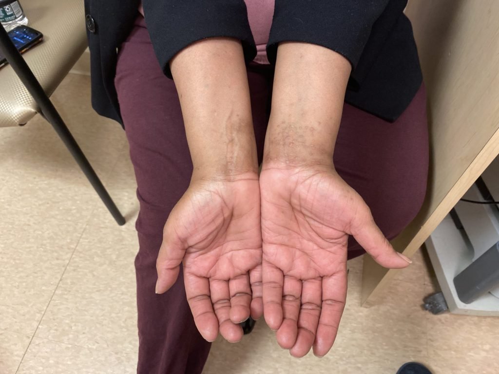 Lichen Planus