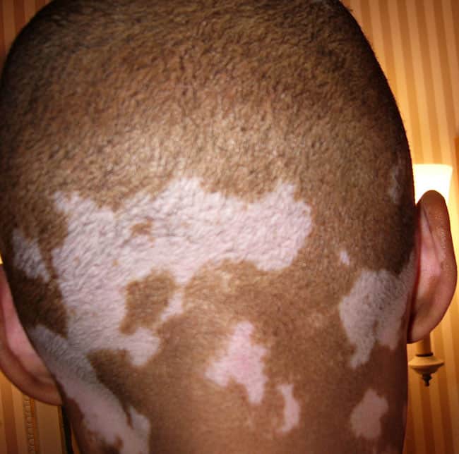 Before Phototherapy on head