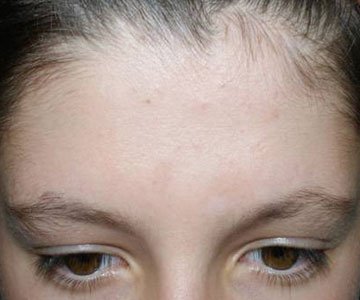 After Phototherapy on forehead and scalp