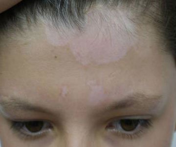 Before Phototherapy on forehead and scalp