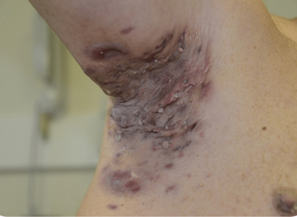 Hidradenitis Suppurativa