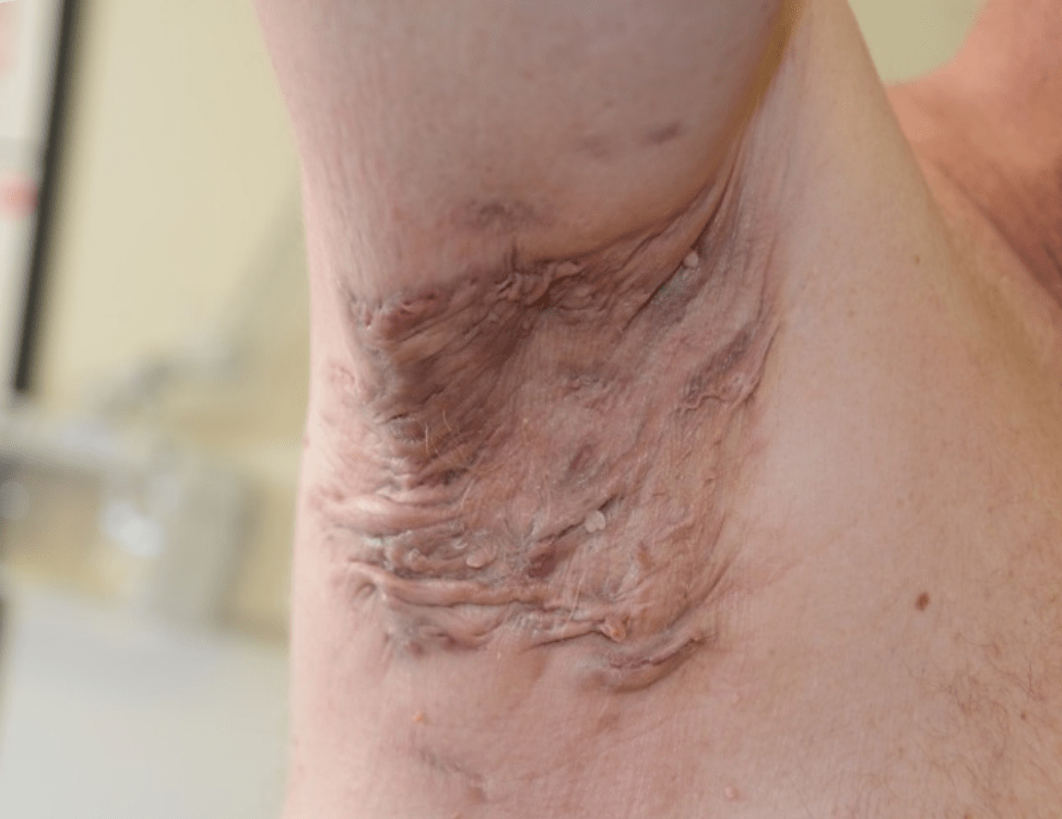 Hidradenitis Suppurativa