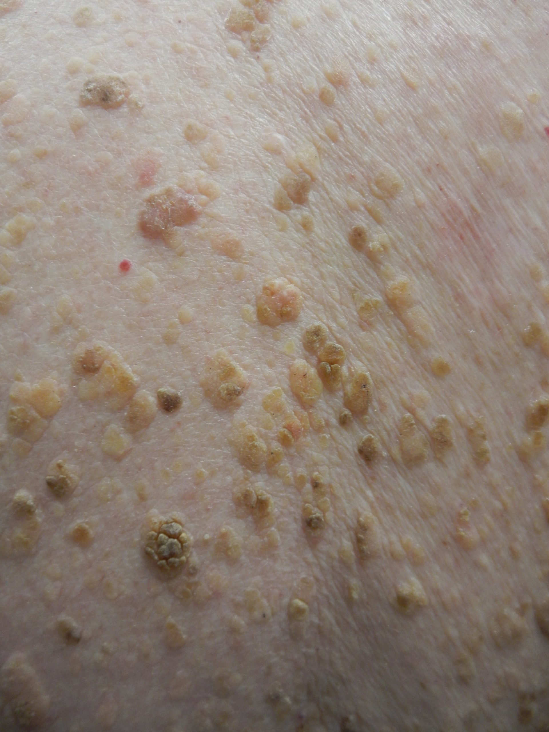 Seborrheic Keratosis Seborrheic Keratosis Clinical Pathology