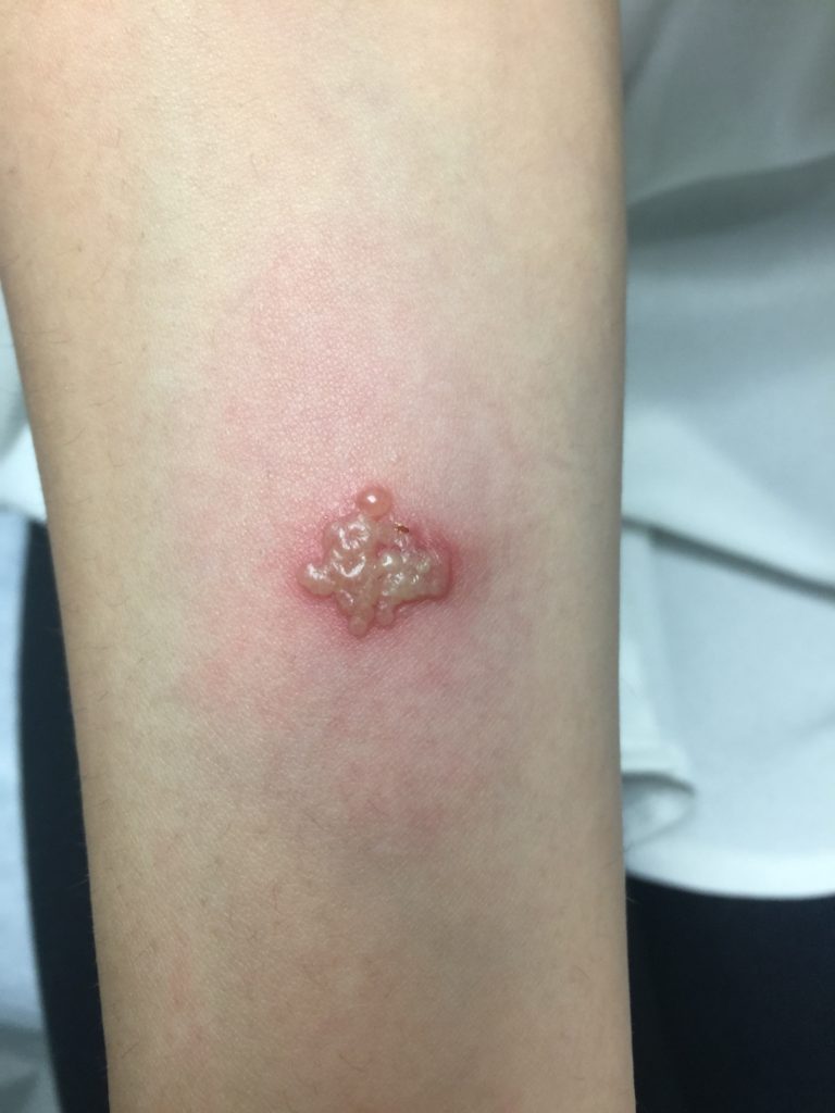 Herpes Simplex Virus
