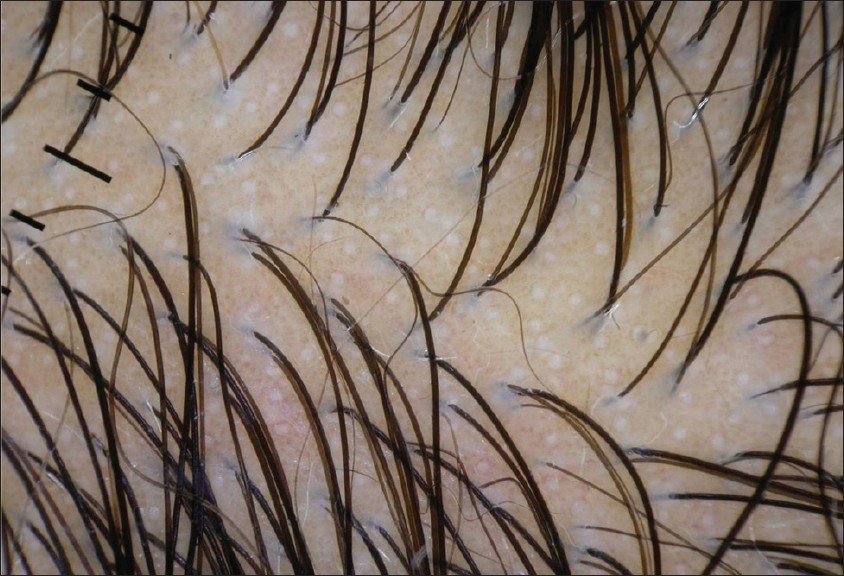 Hair Loss Scalp