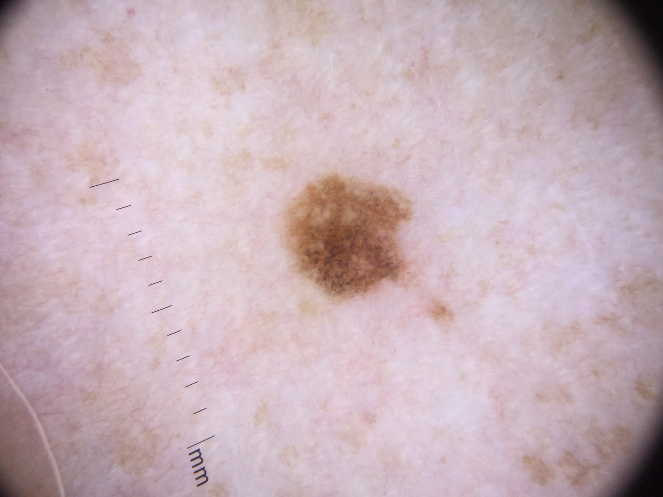 Atypical Nevus