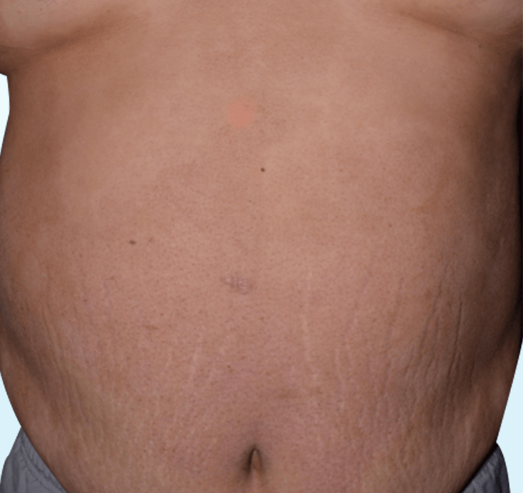 Psoriasis aftertreatment on stomach