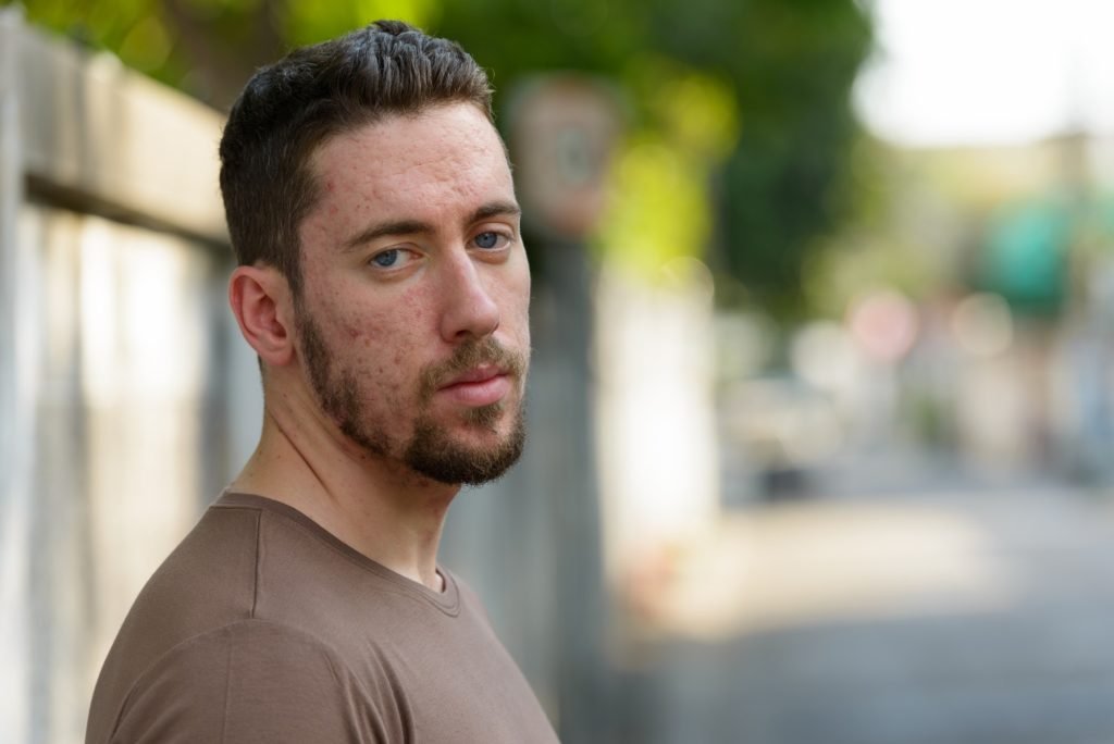 Face of young Caucasian man with acne skin outdoors