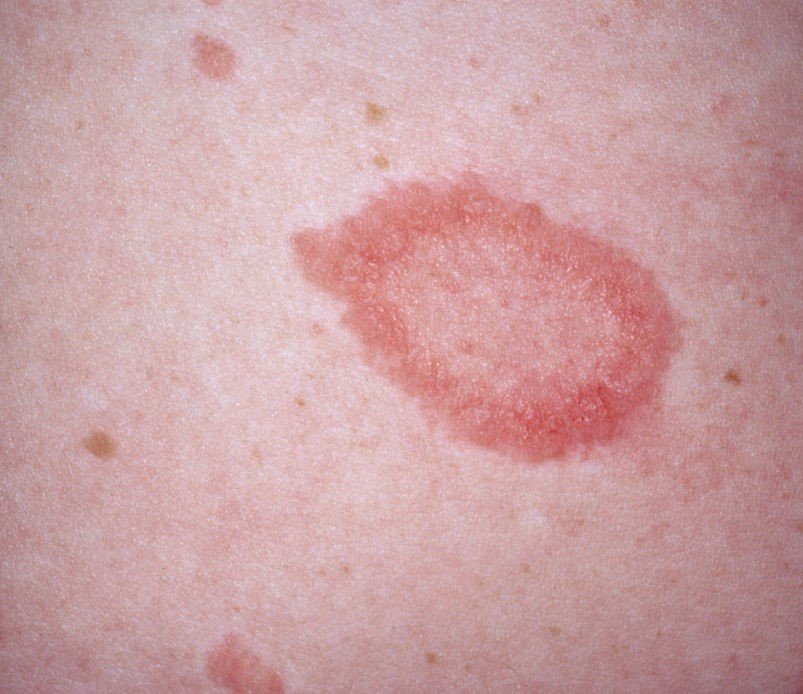 pityriasis rosea christmas tree pattern