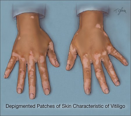 Vitiligo on Hands