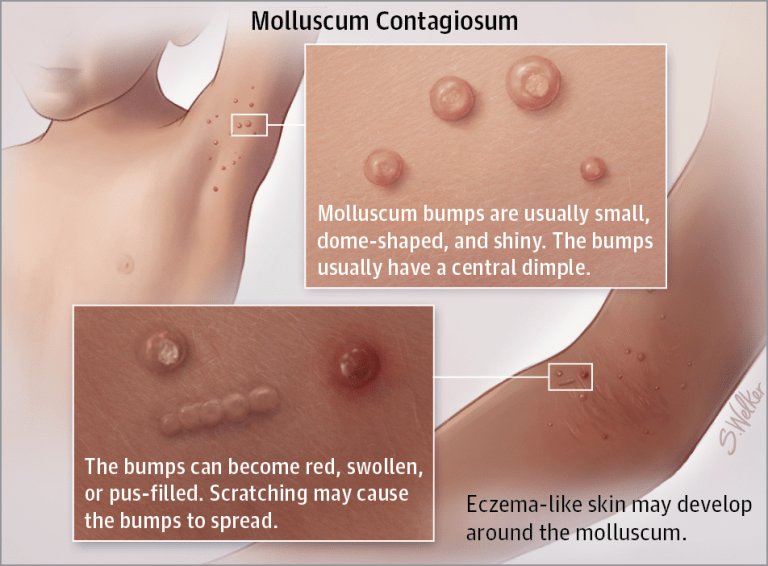 Molluscum Contagious diagram