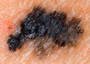 Skin cancer border irregularity