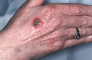 skin cancer on hand