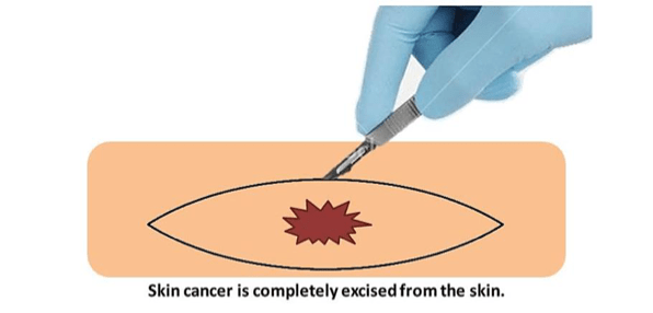 Skin cancer removal diagram