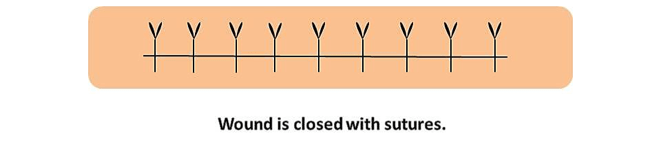 Sutures diagram