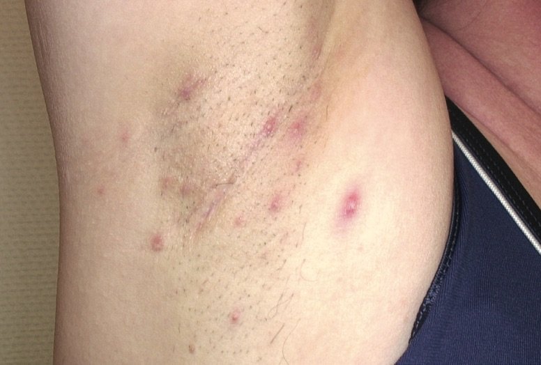 Hidradenitis Suppurativa
