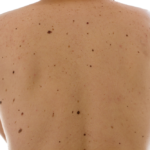 Six Preventative Steps For Avoiding Skin Cancer