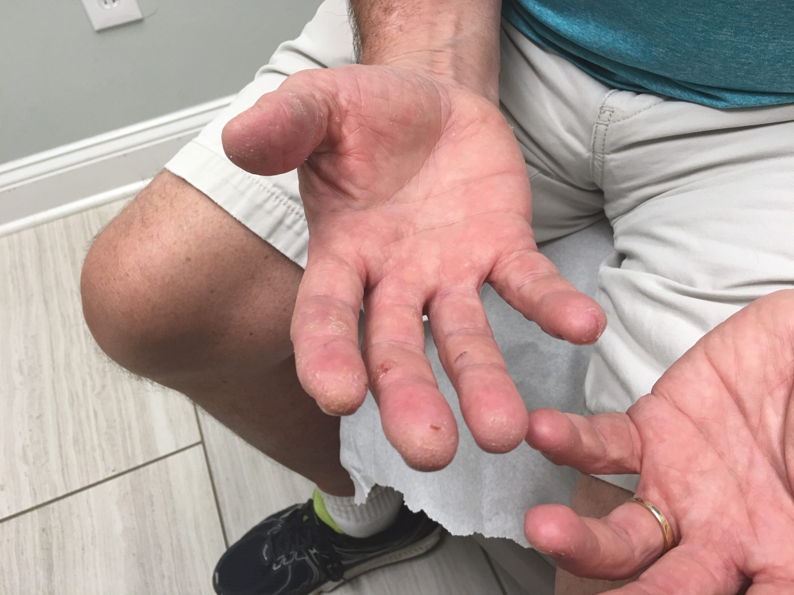 after skin disorder treatment