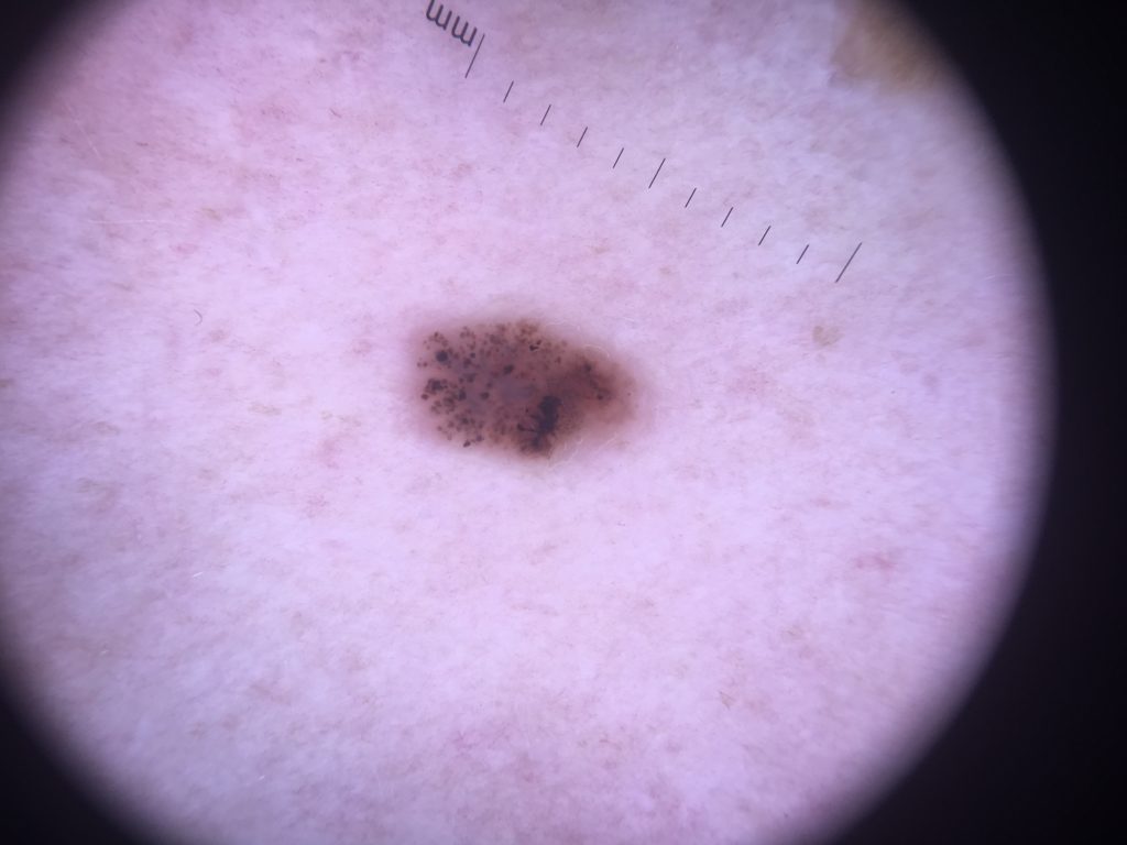 dermoscopy mole check