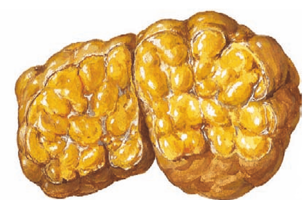 lipoma