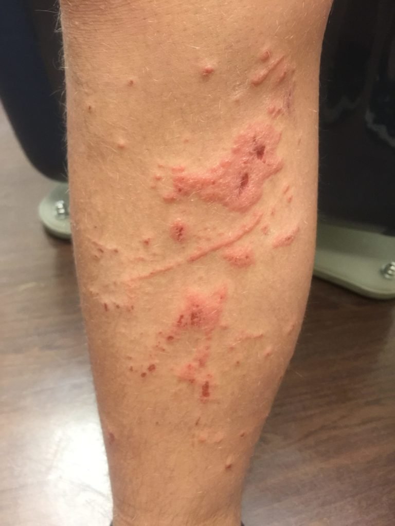 skin disorder