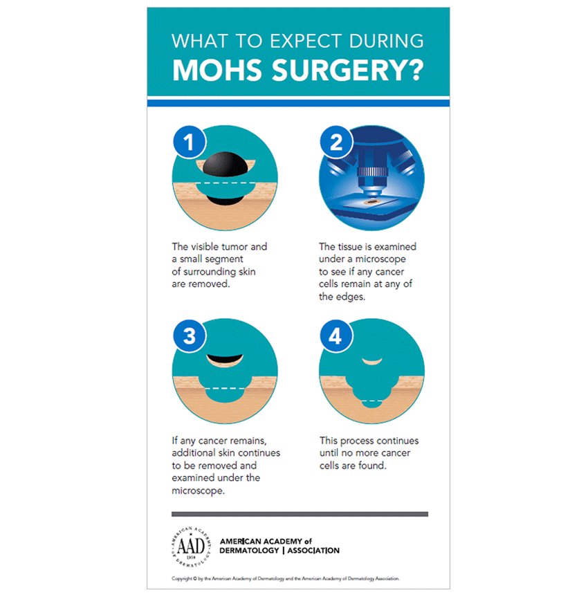 mohs surgery What-to-Expect-During-Mohs-Surgery-Infographic-thumbnail