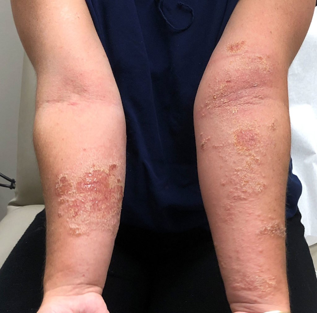 pictures of dermatitis