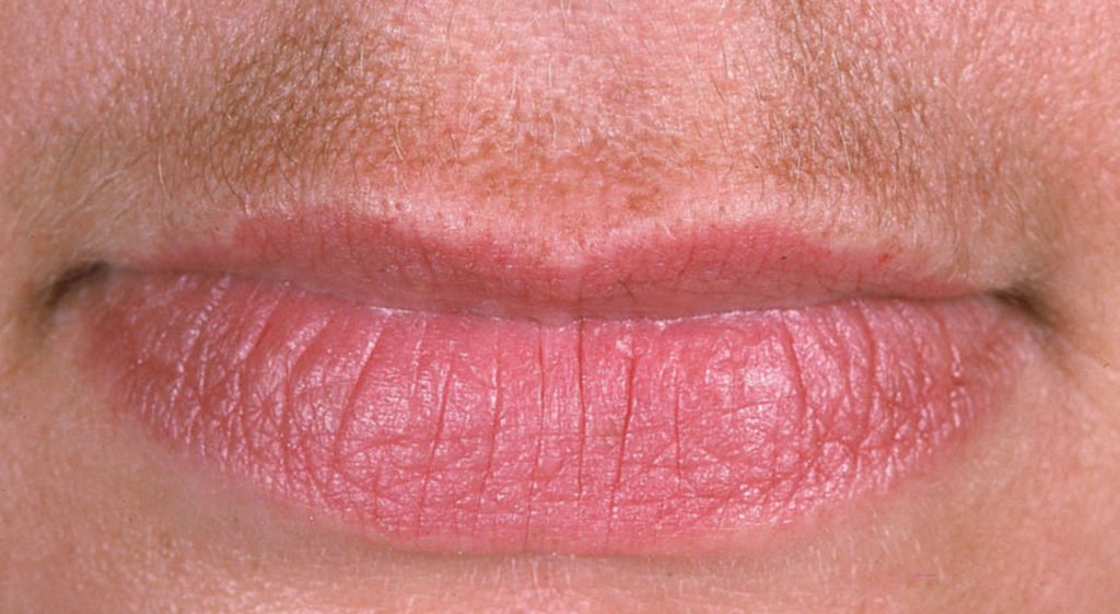 lips skin disorder
