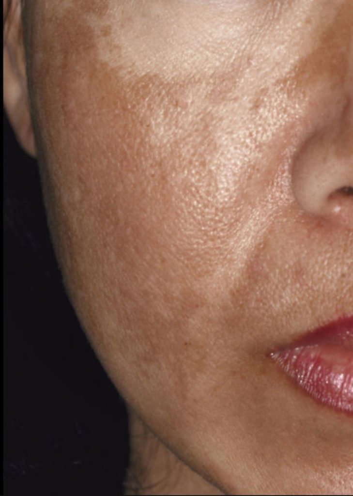 skin disorder