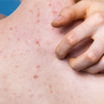 Which Treatments Will Work Best for Back Acne?