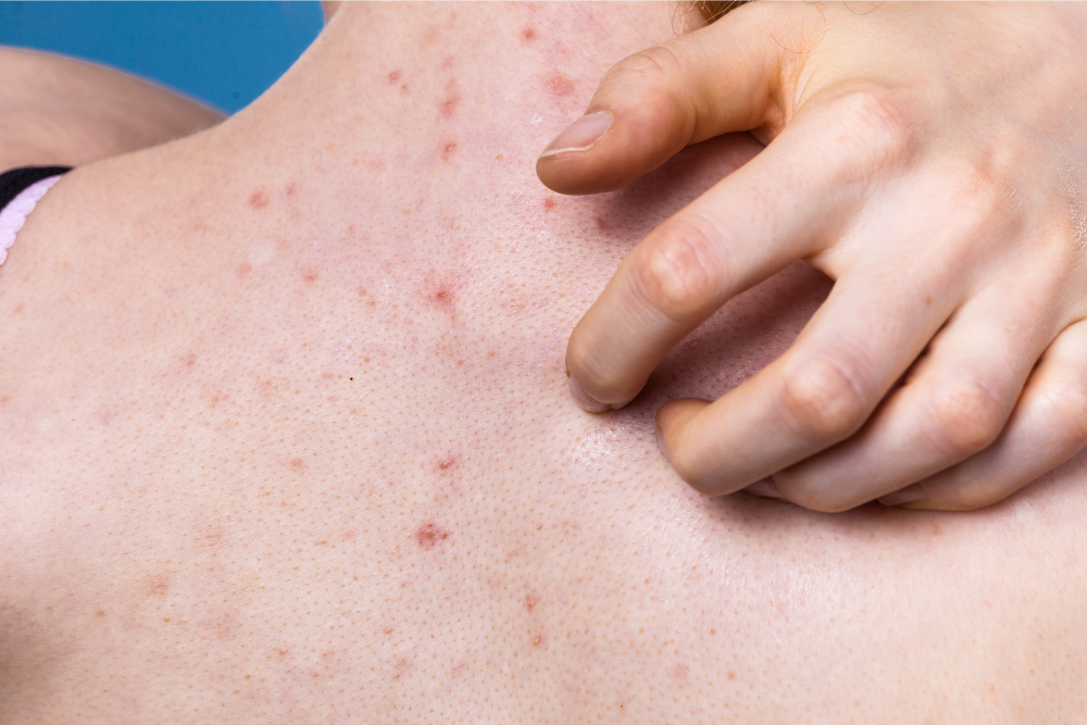 Which Treatments Will Work Best for Back Acne?