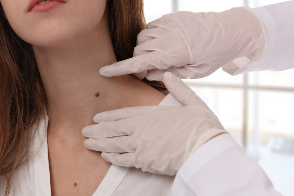 5 Signs You Might Need a Skin Cancer Screening