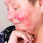 5 Helpful Hints for Dealing With Rosacea