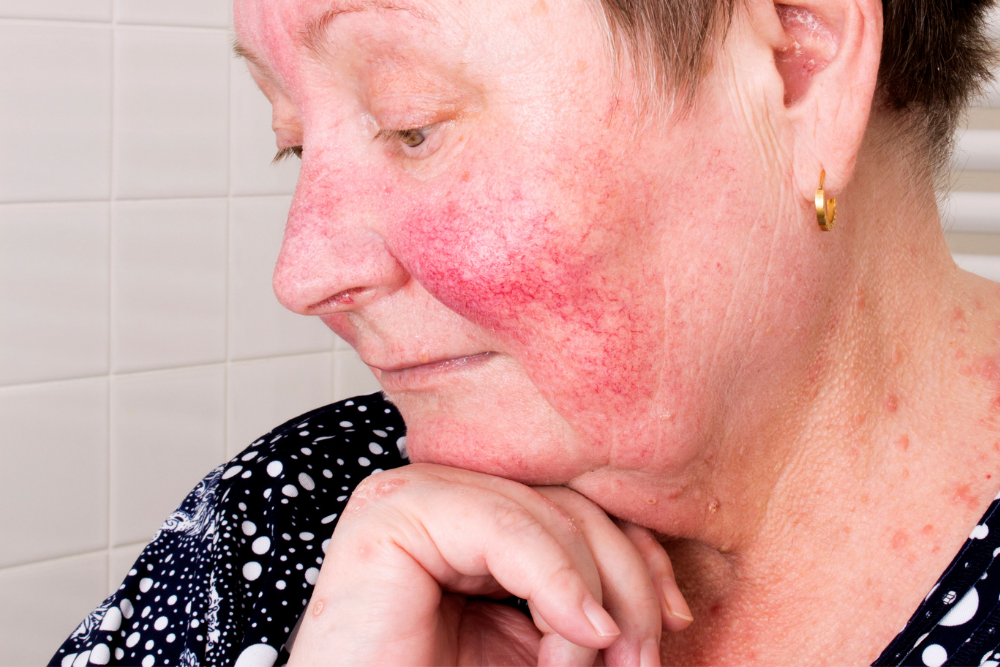 5 Helpful Hints for Dealing With Rosacea