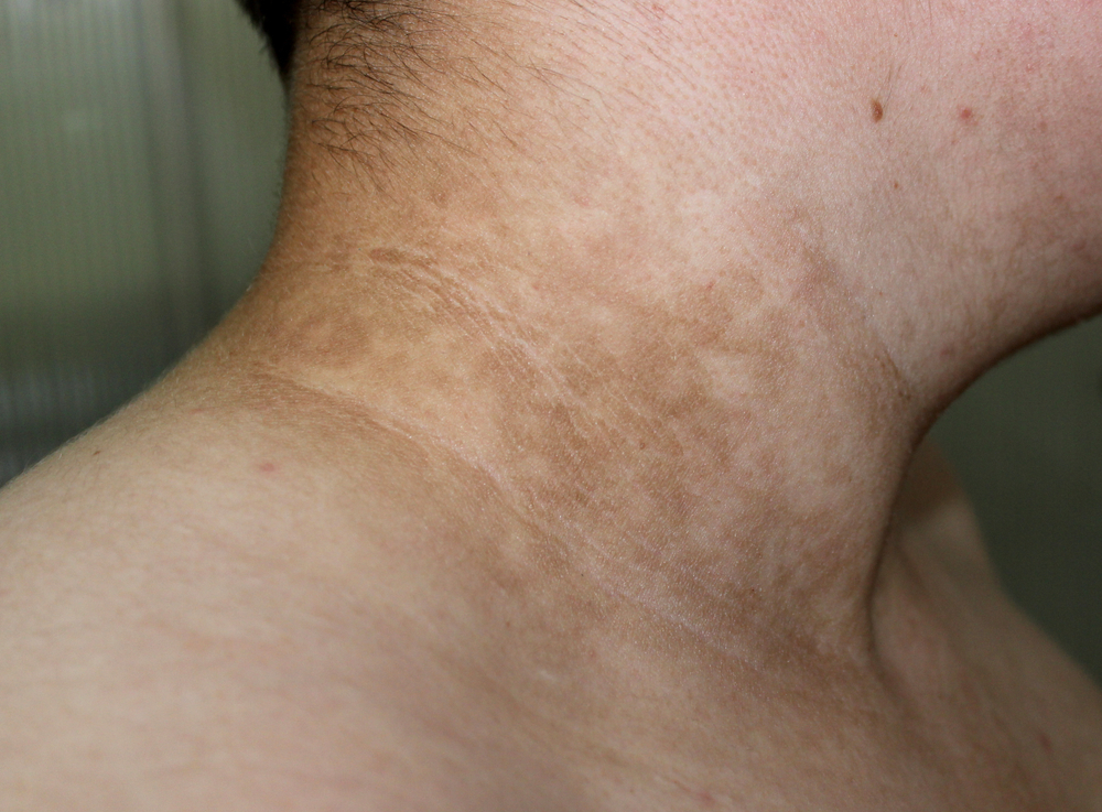 Which Treatments Will Work Best for Hyperpigmentation?