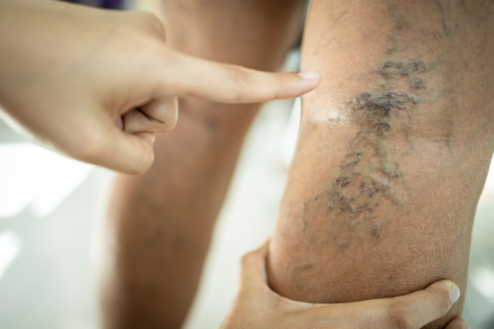 Best Treatments For Varicose Veins