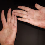 Dermatologist Treatment for Hand Eczema
