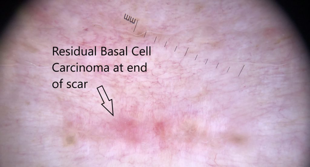 residual basal cell carcinoma at end of scar