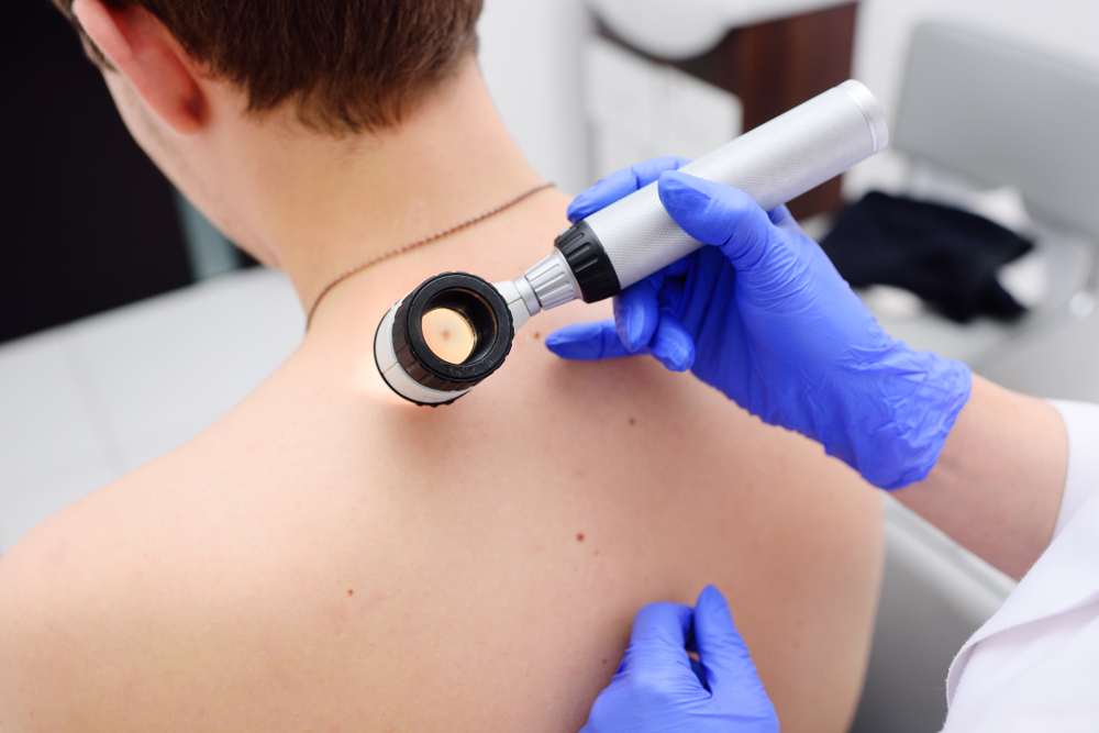 How We Treat Melanoma at Pennsylvania Dermatology Specialists