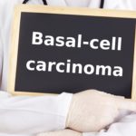 Basal Cell Carcinoma VS Other Carcinomas