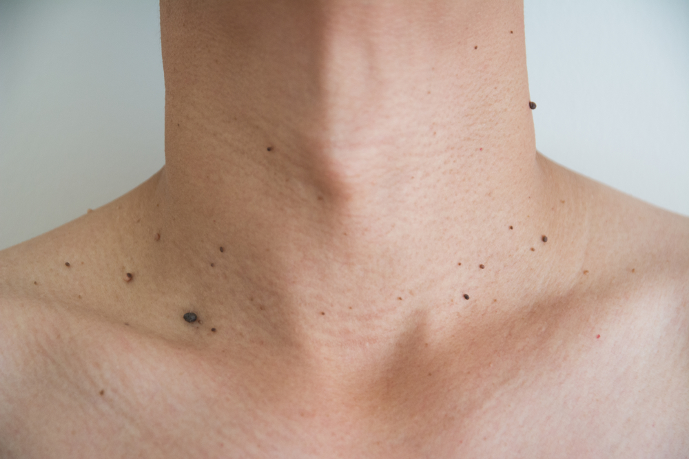 What to Expect at Your Mole Evaluation