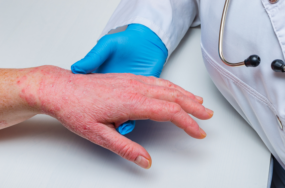 3 Major Differences Between Psoriasis and Eczema