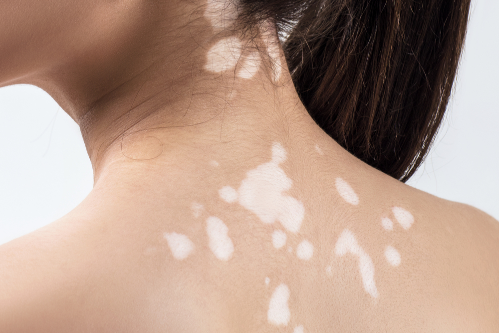 How Can I Help My Vitiligo in Addition to Phototherapy