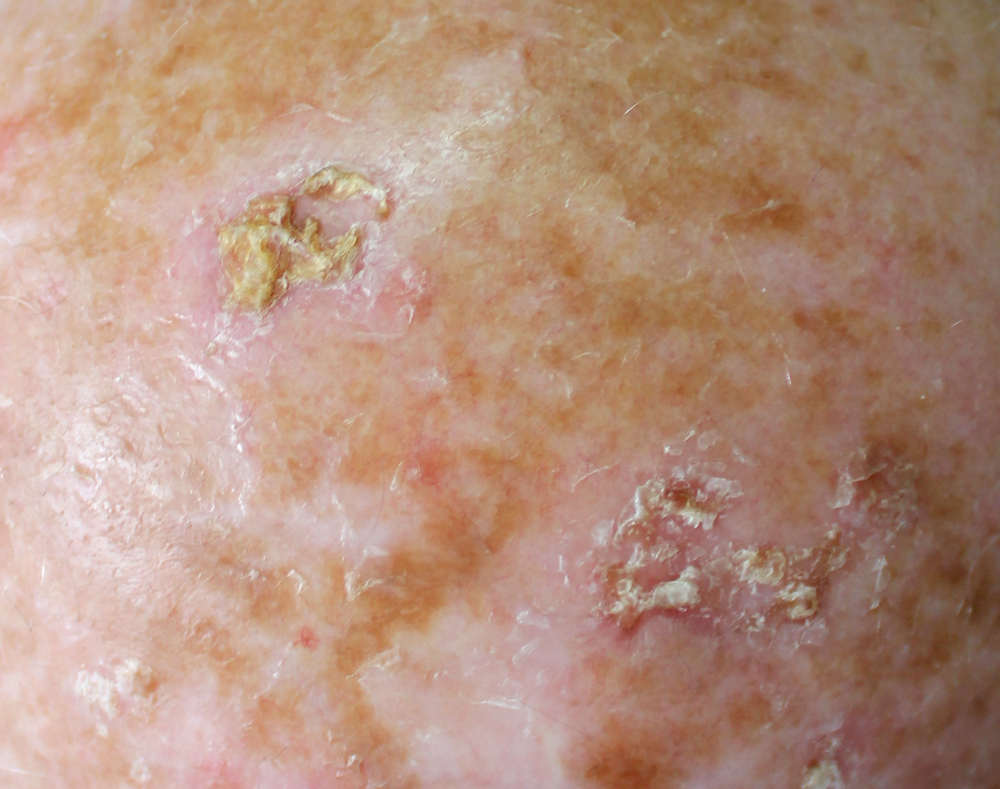 The Relationship between Actinic Keratoses & Cryosurgery