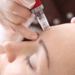 What Does Microneedling Do